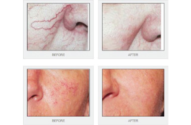 Thread Vein Removal